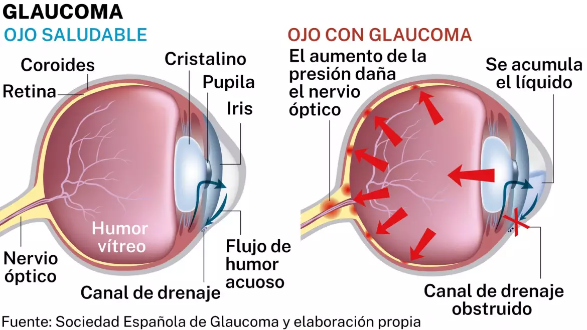 glaucoma_98.webp